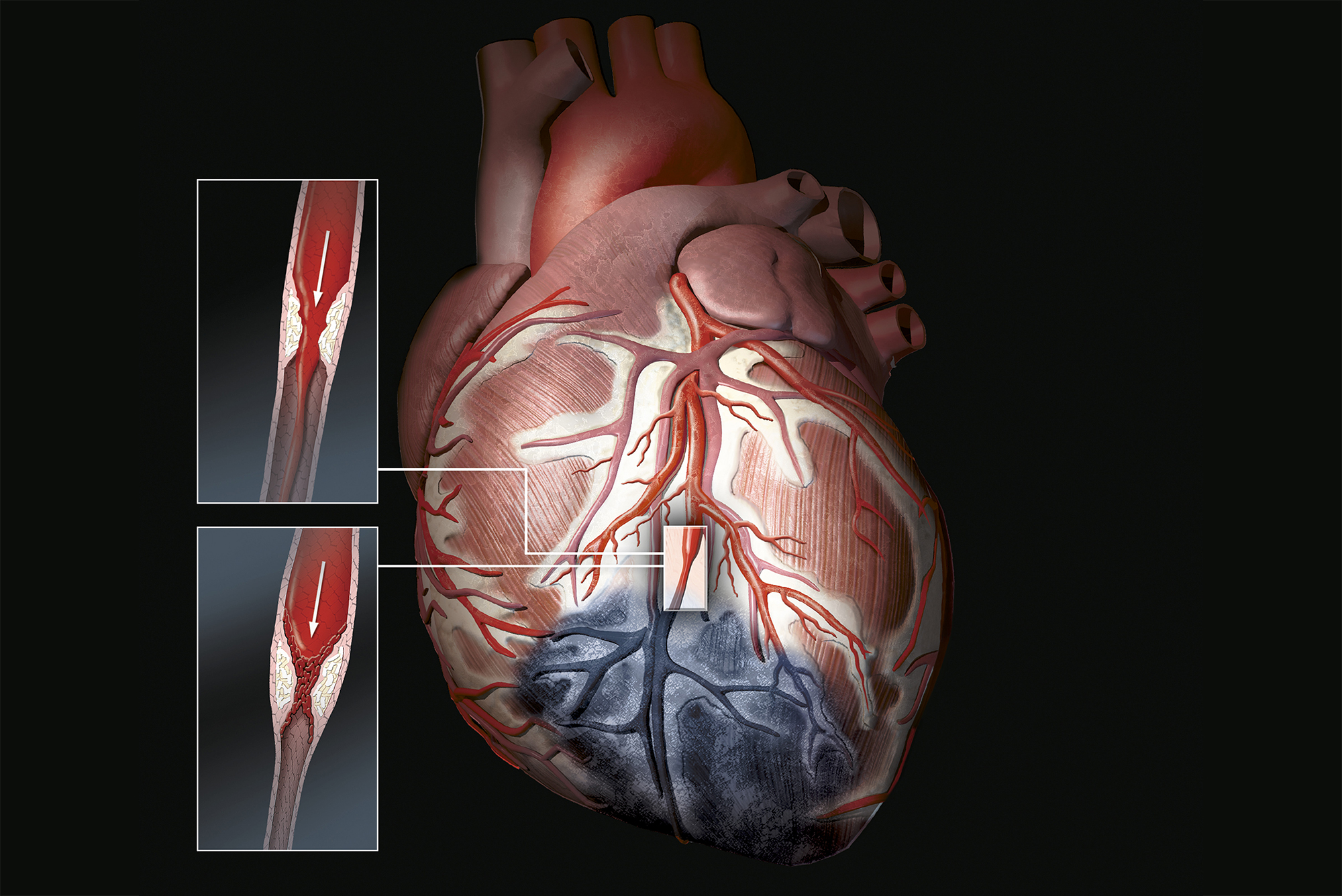 A new global definition of myocardial infarction