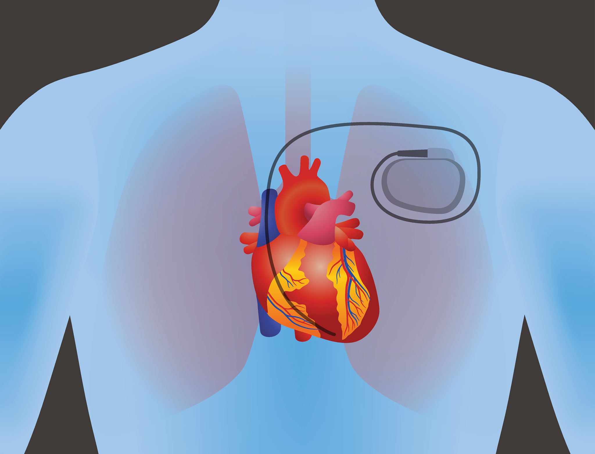 In situ assembly of an injectable cardiac stimulator