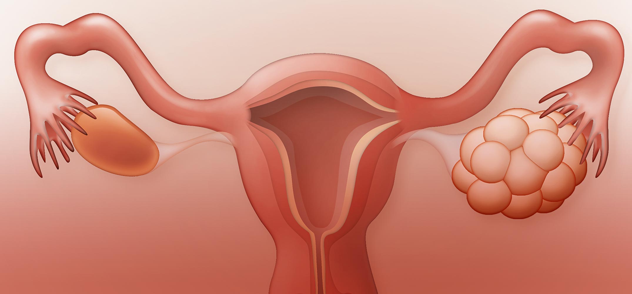 Polycystic Ovary Syndrome: A Hidden Risk for Metabolic and Cardiovascular Diseases?